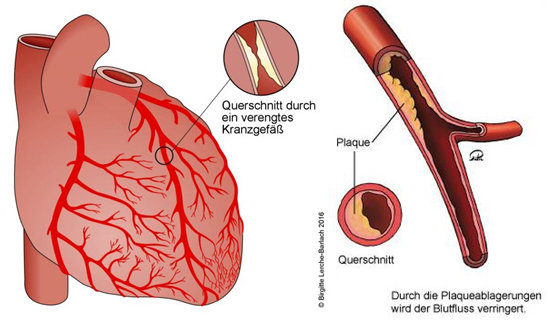 Kardiologie - Herzkranzgefäße